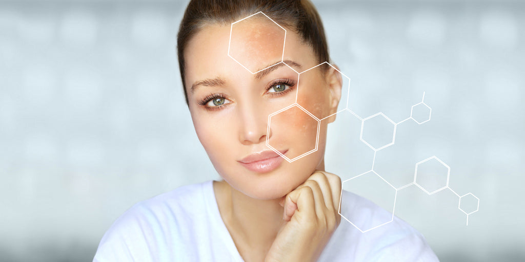 Melasma During Pregnancy